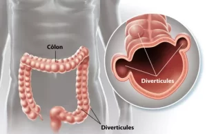 Diverticulite et Consommation d’Alcool : Risques et Conseils Diverticulite et Consommation d'Alcool