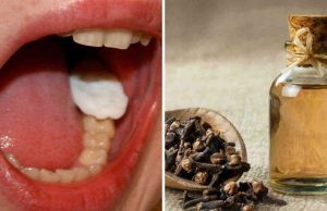 Soulager le Mal de Dent avec le Clou de Girofle : Méthodes et Précautions Mal de Dent avec le Clou de Girofle