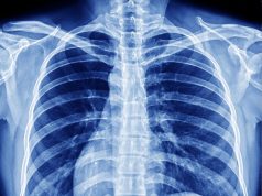 Nodule Spiculé : Comprendre ce Signe Radiologique Clé Nodule Spiculé