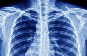 Nodule Spiculé : Comprendre ce Signe Radiologique Clé Nodule Spiculé