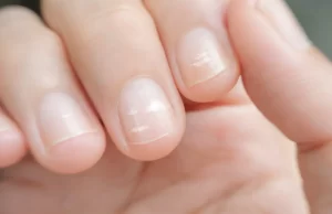 Ongles Blancs et Roses : Signes de Santé ou d’Alerte ? Ongles Blancs et Roses