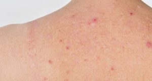 Comprendre et Traiter les Pointes de Rubis sur la Peau Pointes de Rubis sur la Peau