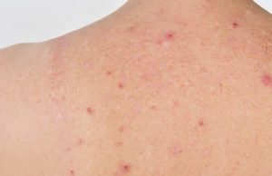 Comprendre et Traiter les Pointes de Rubis sur la Peau Pointes de Rubis sur la Peau