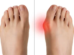 Gérer la Douleur Lancinante Post-Opératoire de l’Hallux Valgus douleur Hallux Valgus