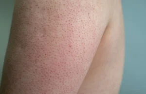 Lutter contre la Peau de Fraise : Conseils et Solutions Efficaces