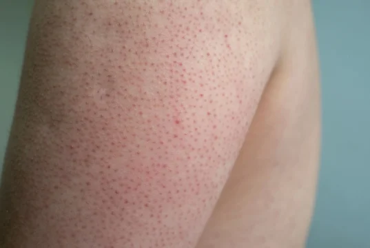 Lutter contre la Peau de Fraise : Conseils et Solutions Efficaces
