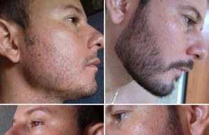 Minoxidil pour la Barbe : Miracle de Croissance ou Mythe ? Minoxidil pour la Barbe
