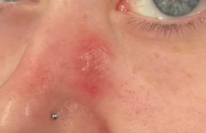 Comment Éviter les Traces Rouges sur le Nez avec Vos Lunettes ? Taches Rouges sur le Nez Lunettes