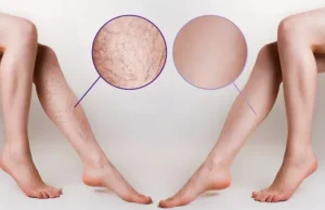 Veinaritin avis : soulagez vos varices efficacement Veinaritin avis