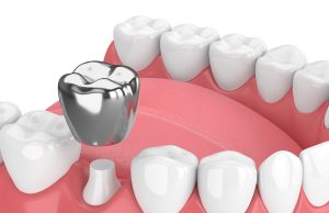 Couronne métallique : quels sont les dangers et les précautions à prendre ? Couronne métallique dangers