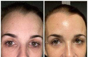 Découvrez les effets avant/après d’un soin visage Starvac avant:après d’un soin visage Starvac