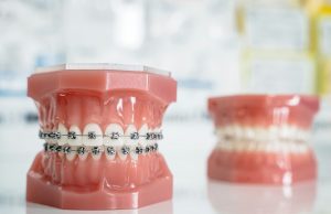 Orthodontie interceptive vs corrective : quelles différences ? Différences entre orthodontie interceptive et corrective