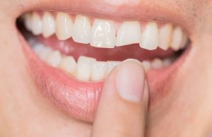 Dent cassée : premiers gestes à adopter avant de voir un dentiste dent cassée : que faire en attendant le dentiste
