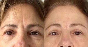 HIFU : quels sont les avis négatifs et les risques à connaître ? hifu avis négatif