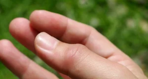 Doigt ressaut : solutions naturelles pour soulager et traiter ce trouble soigner naturellement un doigt ressaut