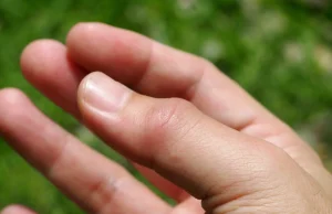 Doigt ressaut : solutions naturelles pour soulager et traiter ce trouble soigner naturellement un doigt ressaut