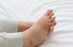 Algodystrophie : peut-on guérir de cette maladie invalidante ? algodystrophie
