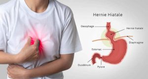 Hernie hiatale et stress : quel lien et comment soulager les symptômes ? hernie hiatale stress