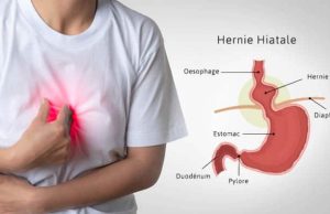 Hernie hiatale et stress : quel lien et comment soulager les symptômes ? hernie hiatale stress