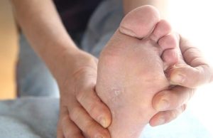 Pieds qui pèlent : causes possibles et solutions Pieds qui pèlent