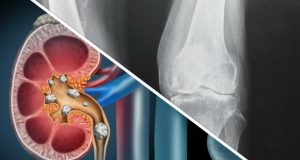 Les microcalcifications sont-elles vraiment dangereuses ? microcalcifications sont-elles vraiment dangereuses