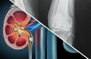 Les microcalcifications sont-elles vraiment dangereuses ? microcalcifications sont-elles vraiment dangereuses