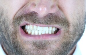 J’ai guéri du bruxisme : mon témoignage et mes solutions jai-gueri-du-bruxisme