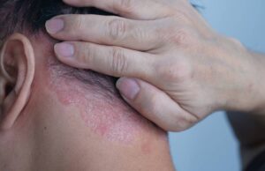 Apaiser naturellement les inflammations du psoriasis image-apaiser-naturellement-les-inflammations-du-psoriasis