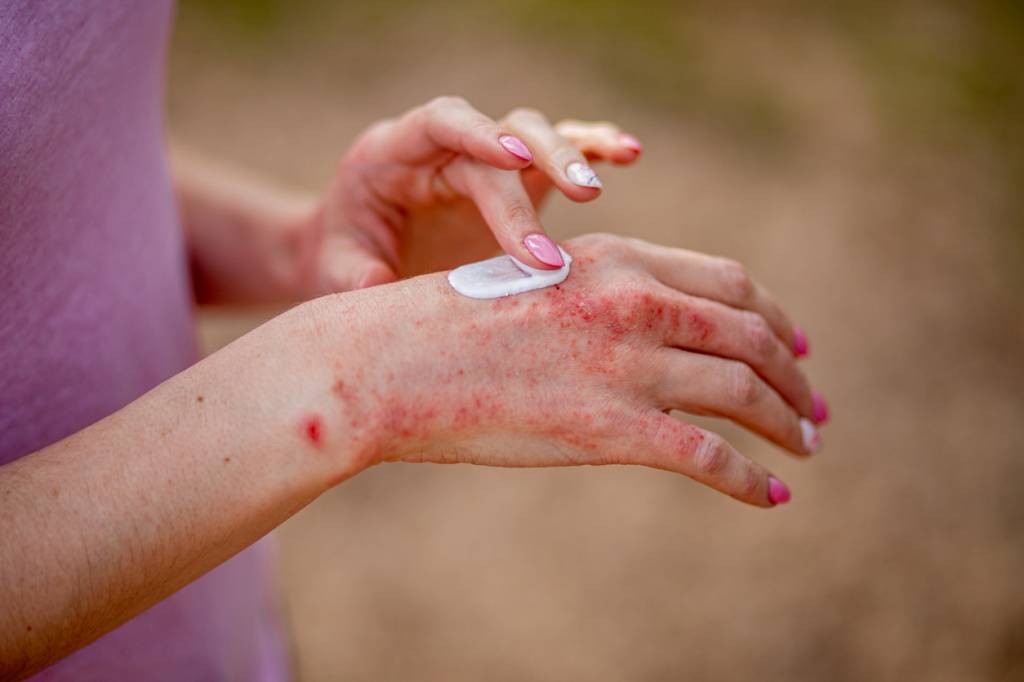 outine anti-eczéma