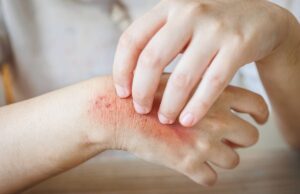 Construire sa routine anti-eczéma : 5 rituels incontournables incontournables-construire