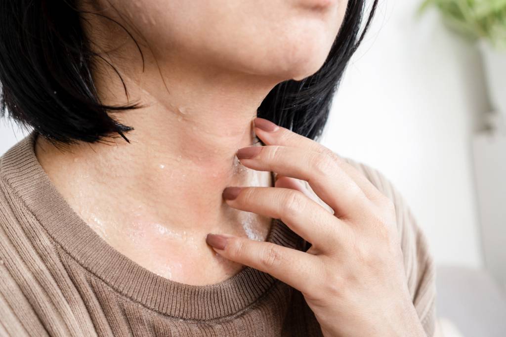 symptômes eczéma