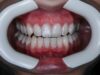 Taches blanches sur les dents : du white spot à la fluorose tache-blanche-sur-les-dents