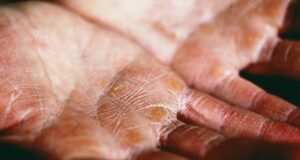 Dyshidrose main : produits et soins recommandés dyshidrose-main