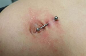 Piercing au nombril rejet : causes, symptômes et solutions piercing-au-nombril-rejet