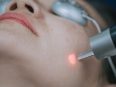 Rosacée laser : prix, efficacité et résultats du traitement rosacee-laser