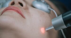 Rosacée laser : prix, efficacité et résultats du traitement rosacee-laser