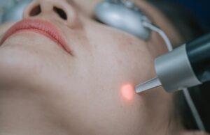 Rosacée laser : prix, efficacité et résultats du traitement rosacee-laser