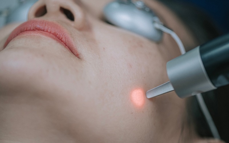 rosacee-laser rosacee-laser