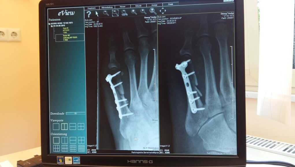 Quel est le temps moyen pour la réparation totale d'une fracture ?