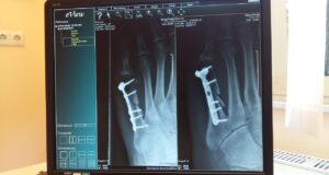 Quel est le temps moyen pour la réparation totale d’une fracture ? Quel est le temps moyen pour la réparation totale d'une fracture ?