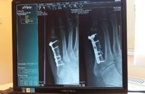 Quel est le temps moyen pour la réparation totale d’une fracture ? Quel est le temps moyen pour la réparation totale d'une fracture ?