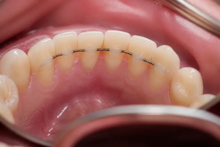 Fil de contention métallique collé derrière les incisives inférieures pour corriger les dents du bonheur