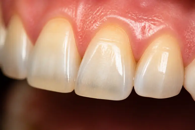 Gros plan macro montrant la structure de l'émail dentaire et la teinte naturelle de la dentine sous-jacente.