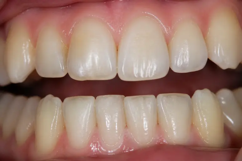 Examen rapproché de la surface dentaire pour distinguer les taches externes de la transparence de la dentine.