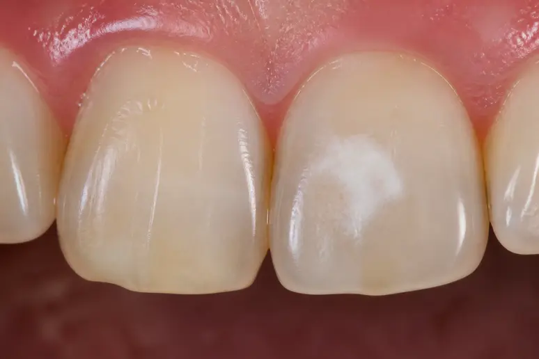 Gros plan sur une tache blanche crayeuse visible sur l'émail d'une dent humaine